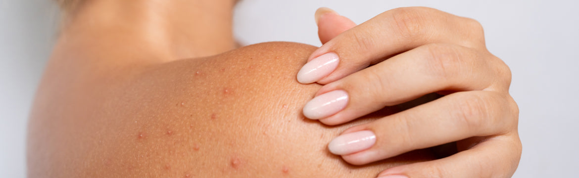 a clean approach to bacne: what causes back acne and how to resolve it naturally